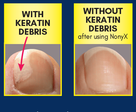 Winter’s warm boots can promote the start of nail fungus, warns Xenna Corporation